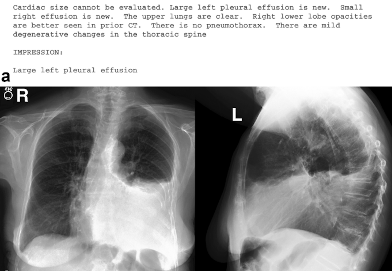 Chest X-Ray VLM