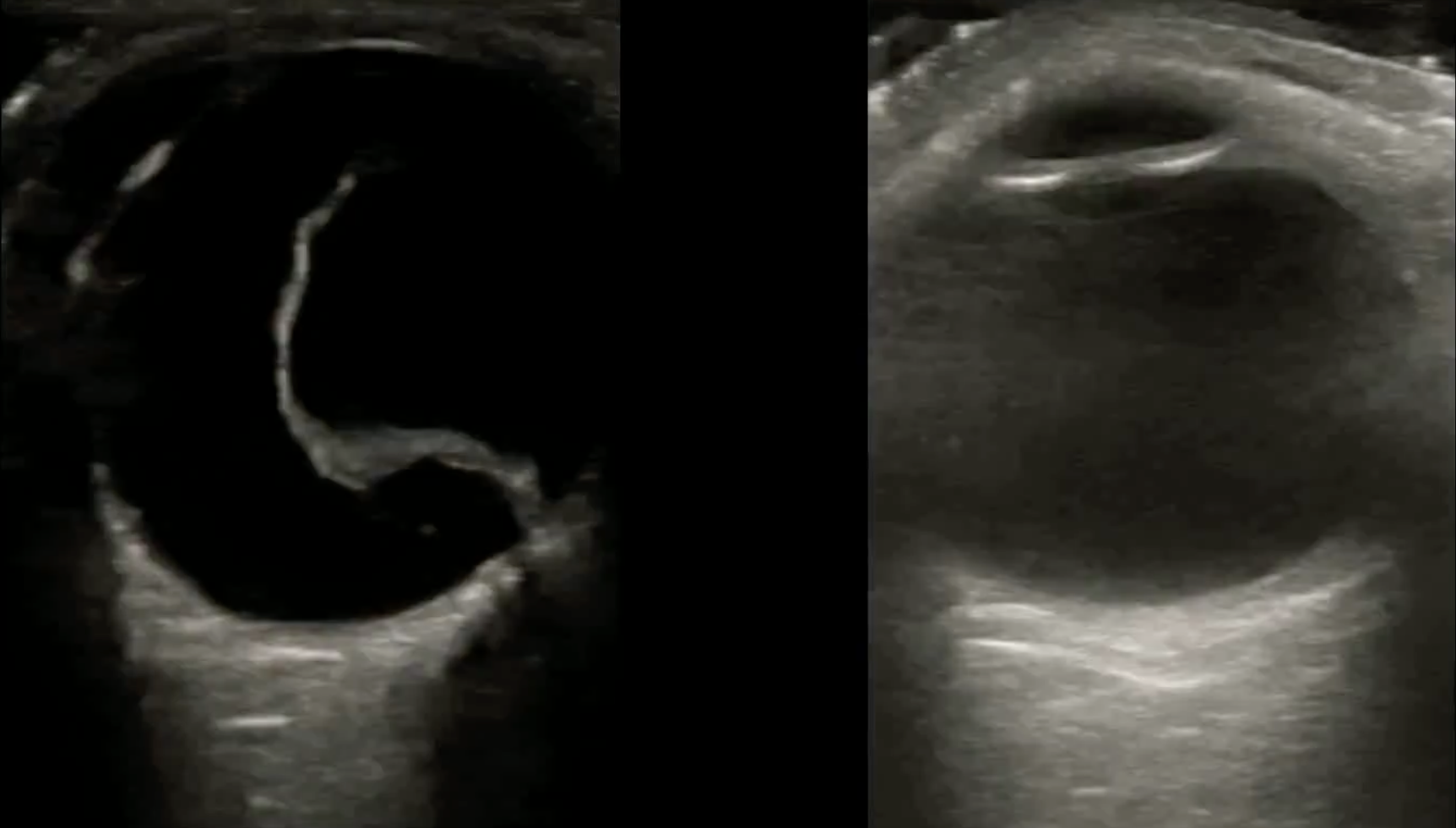 ERDES: A Benchmark Video Dataset for Retinal Detachment and Macular Status Classification in Ocular Ultrasound